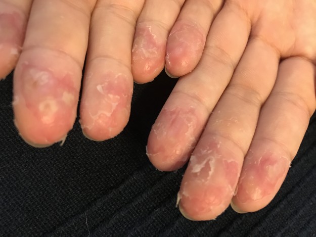 手の皮がむけてヒリヒリと痛い 原因は汗 治った方法や対策はこれ Wakuwakulife